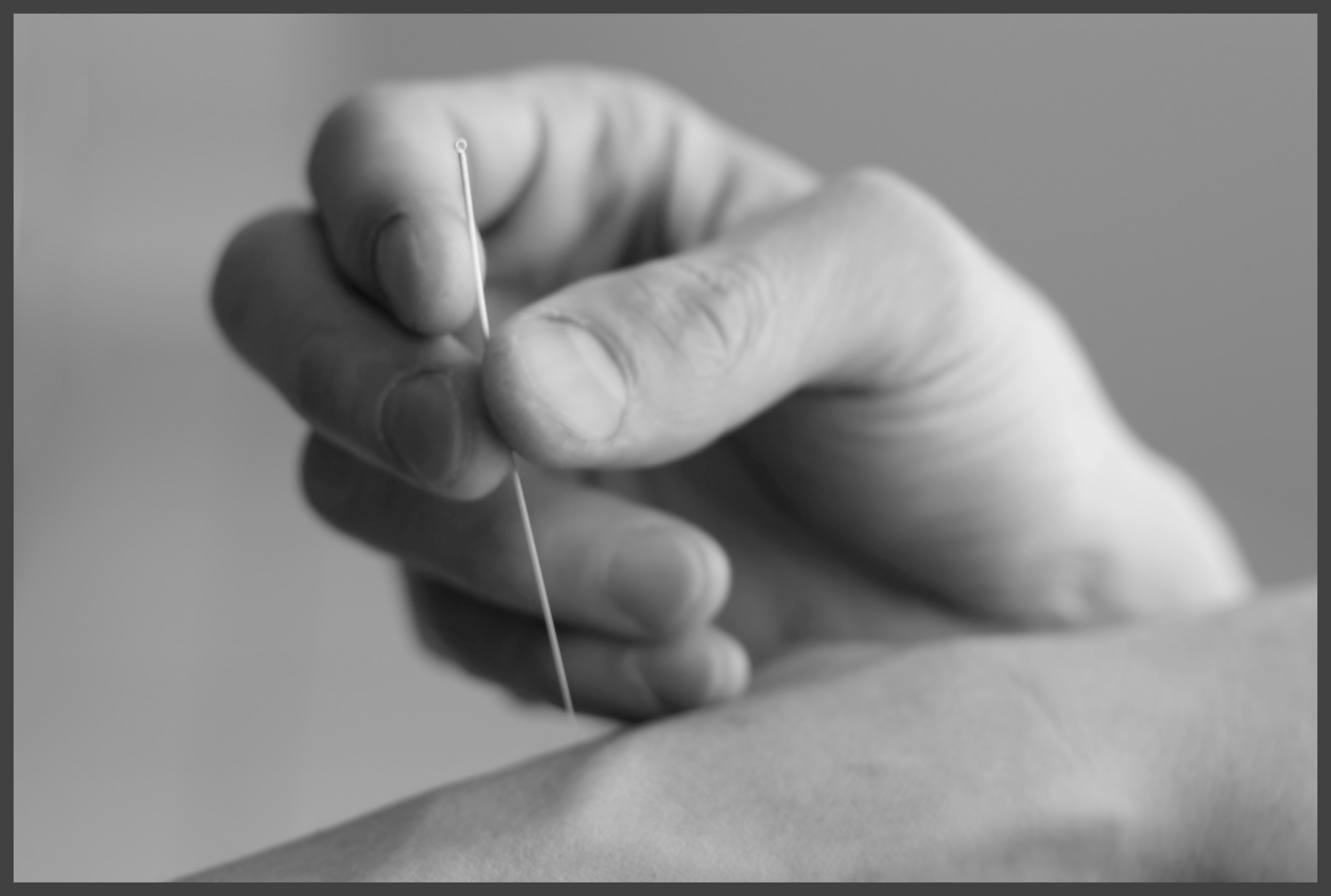 acupuncture bw2 acupuncture bw2